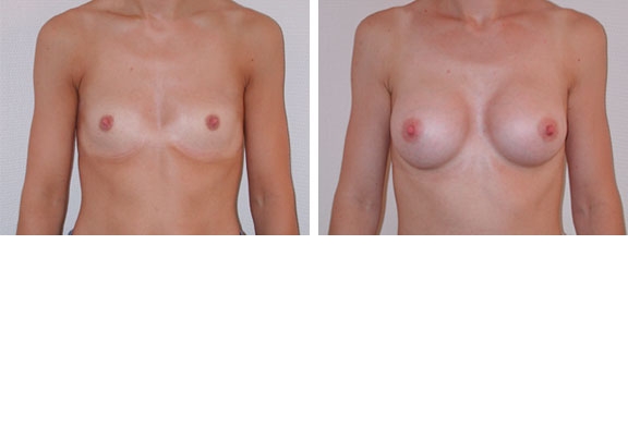 Augmentation mammaire cas n&deg;1 (face)