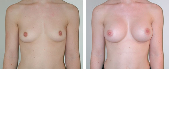 Augmentation mammaire cas n&deg;2 (face)